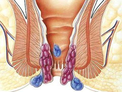 混合痔疮严不严重有多大危害？