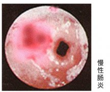 慢性肠炎的病因介绍大连开发区肛肠医院